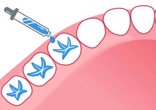窩溝封閉